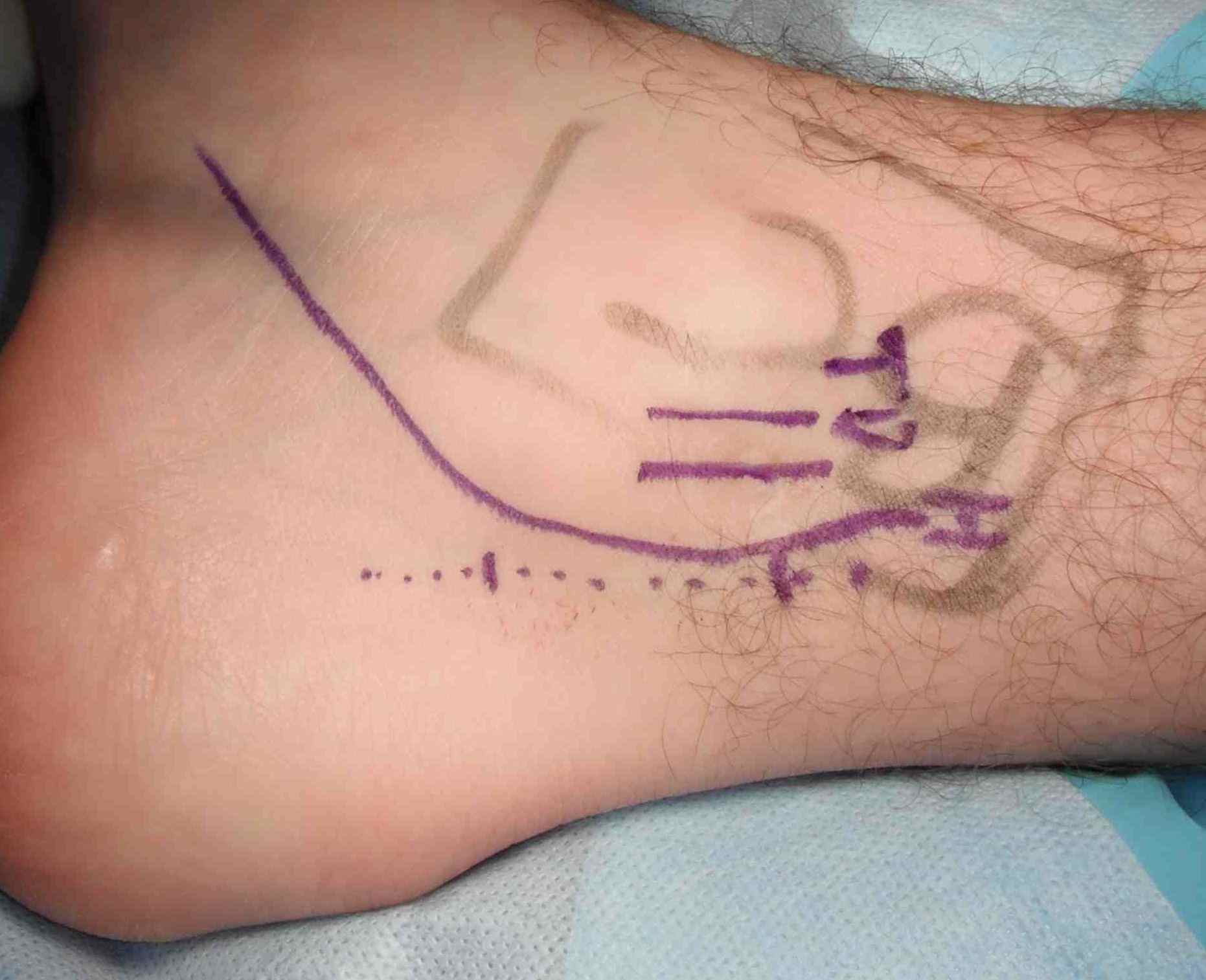 Os Trigonum Skin Marking